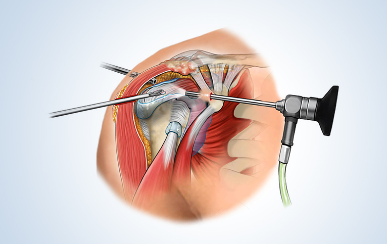 Comprehensive Guide to Shoulder Surgeries