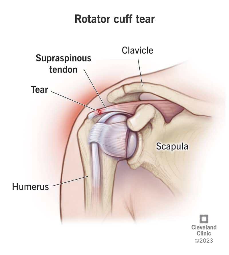 Rotator Cuff Tears: Causes, Types, and Treatment